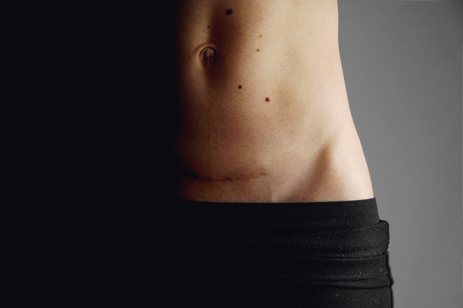 C-section scar on belly