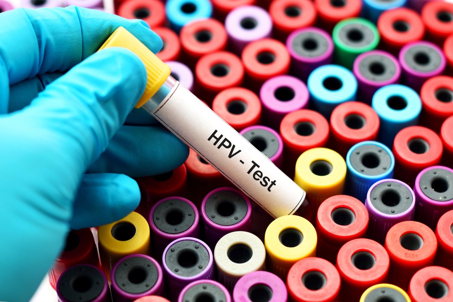 Multiple tubes with one labeled "HPV Test"