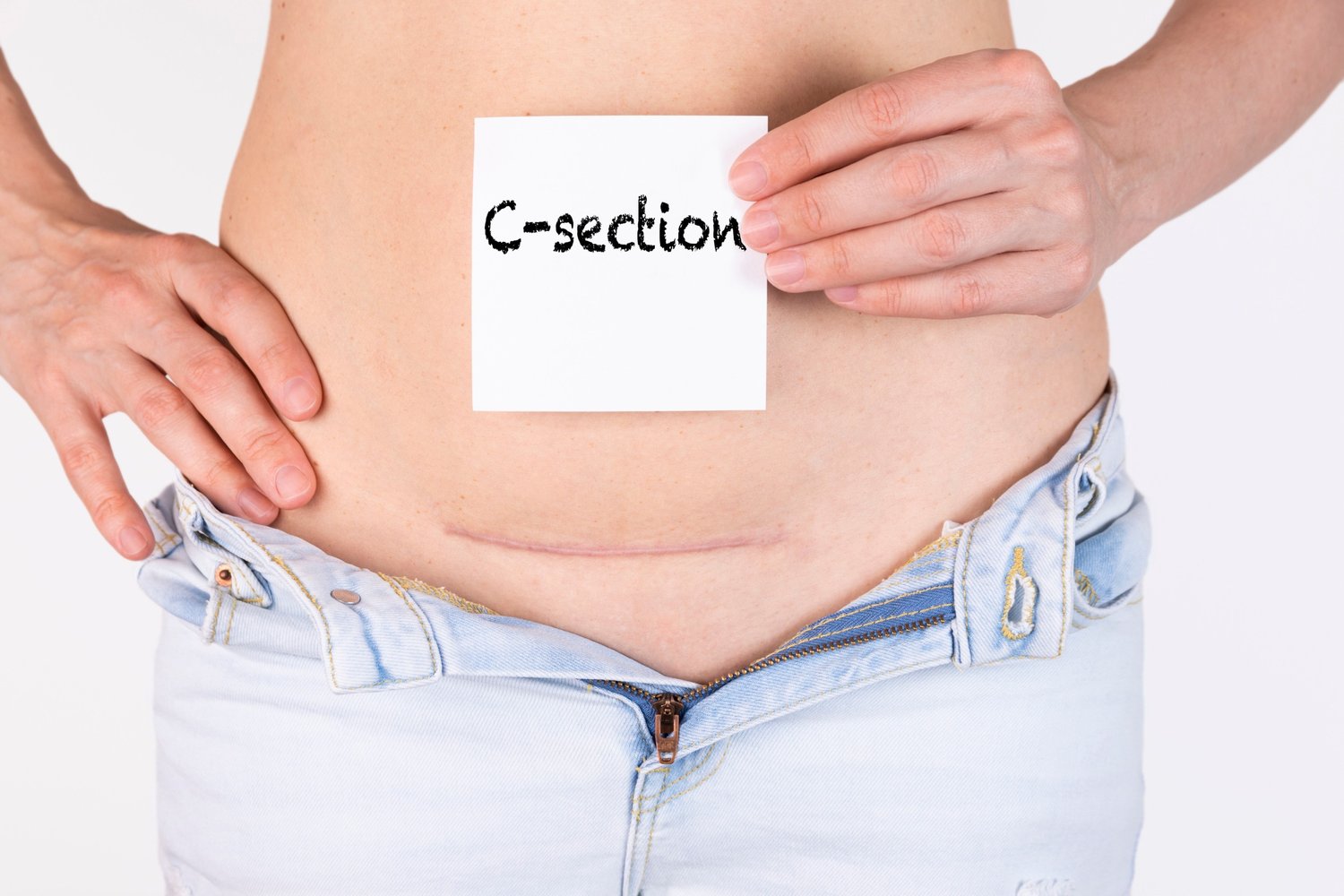Person with c-section scar holding a note with "c-section" written on it